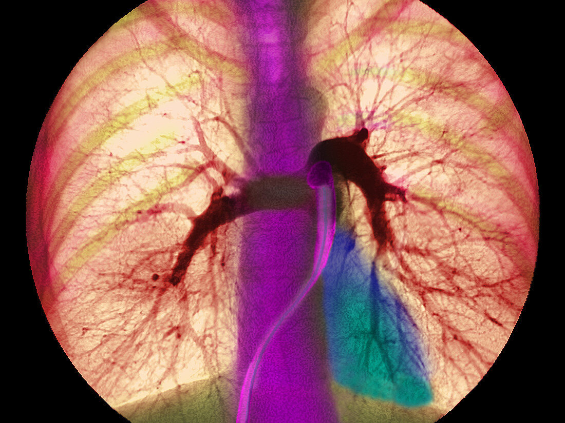 Coloured angiogram showing the pulmonary arteries