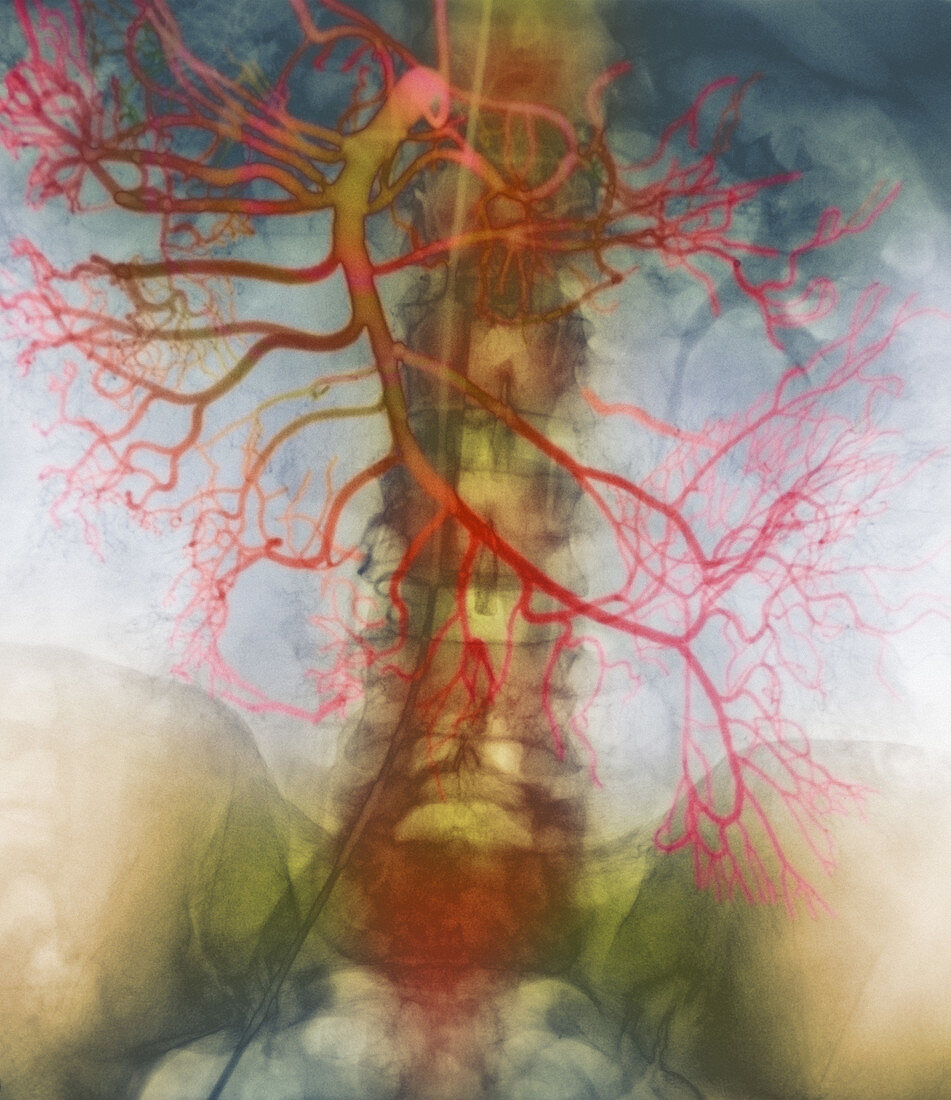 X-ray of arteries