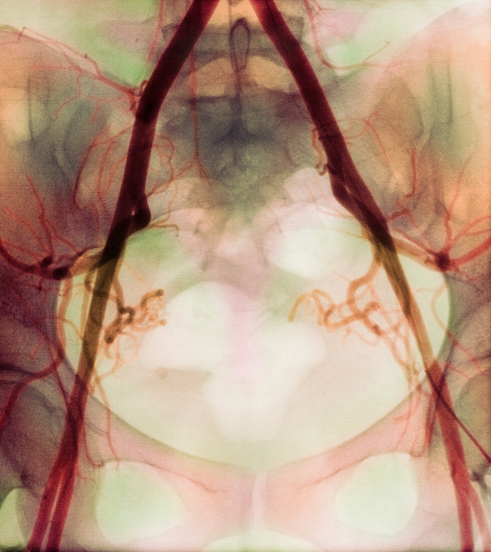 Coloured X-ray of iliac arteries to the pelvis