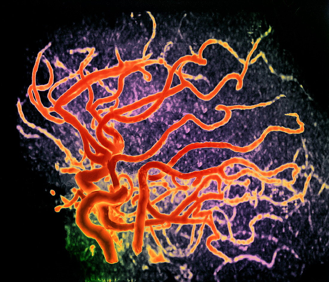 Brain arteries,3-D MRA scan