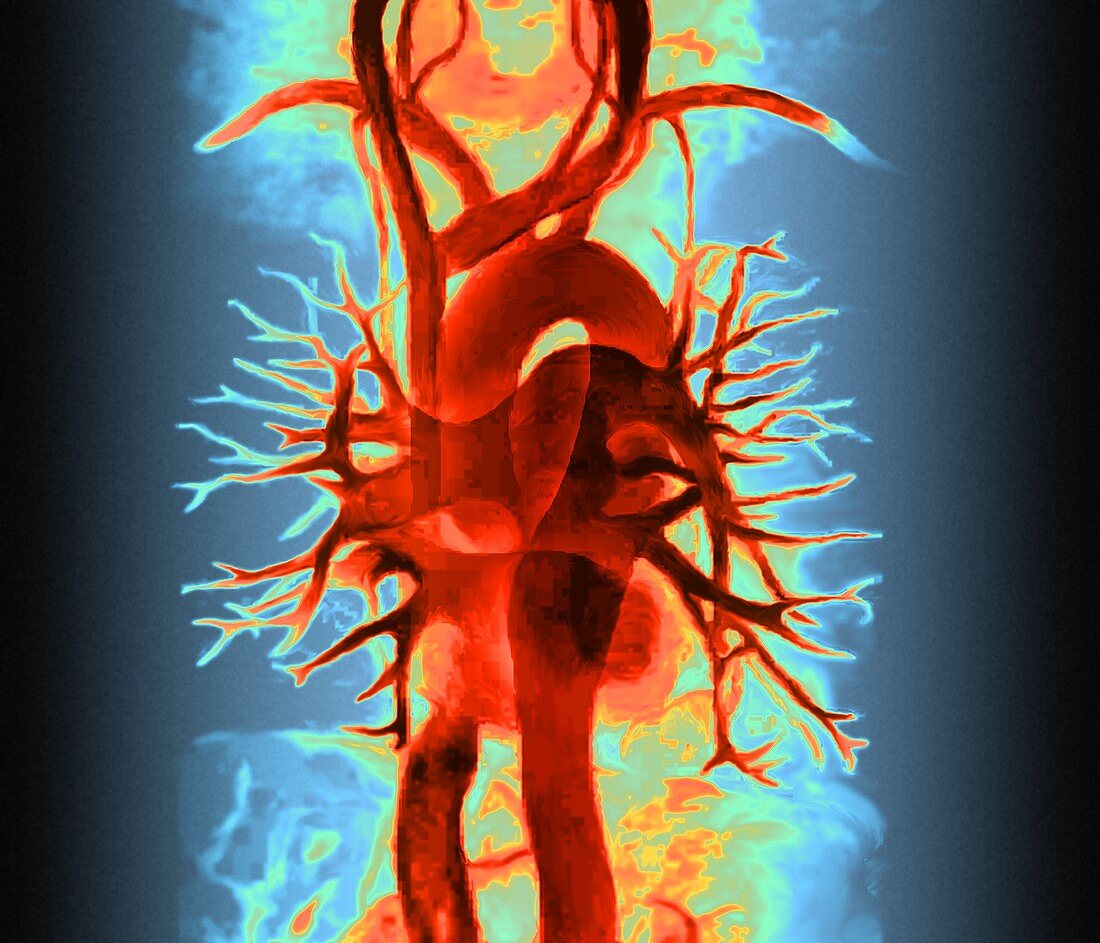 Chest blood vessels,MRA scan