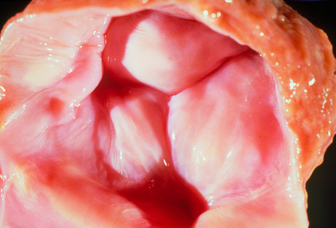 Photograph of a closed pulmonary valve