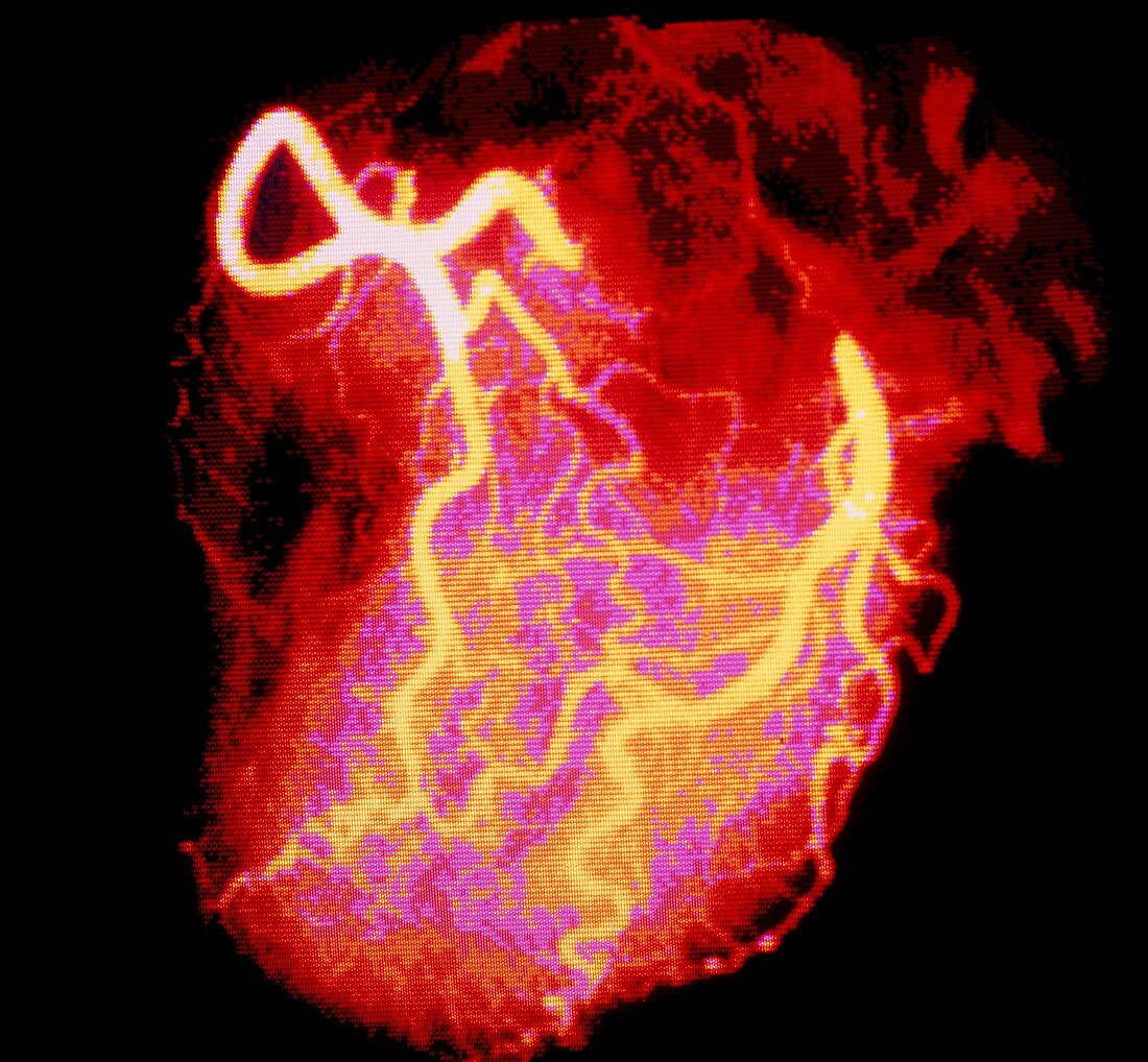 F/col normal coronary angiogram