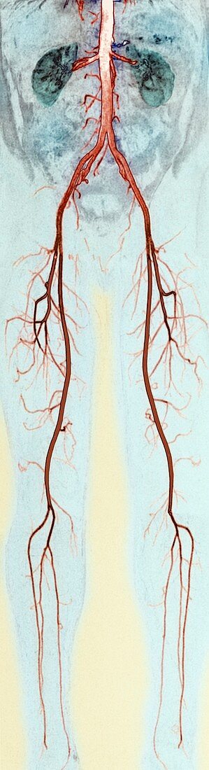 Leg and abdominal blood vessels,MRA scan