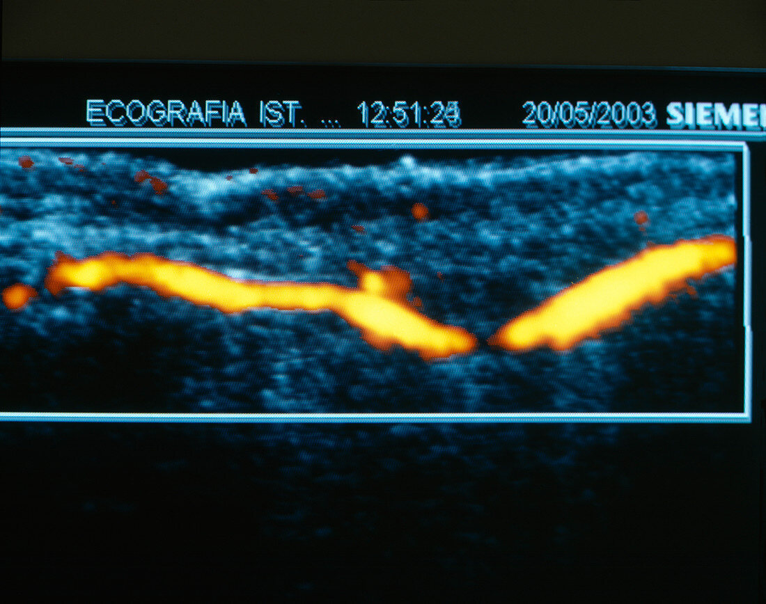Finger blood flow,ultrasound scan