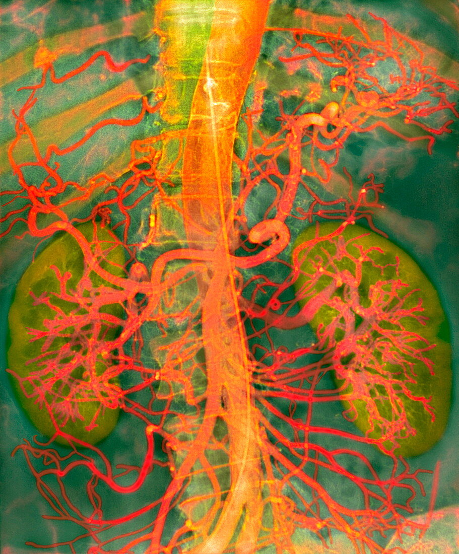 Abdominal arteries,X-ray