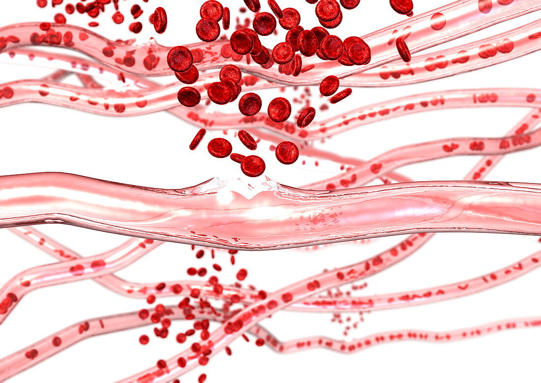 Ruptured blood vessels