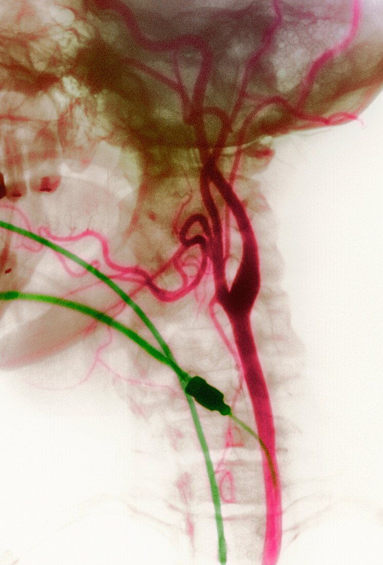 Carotid arteries,X-ray