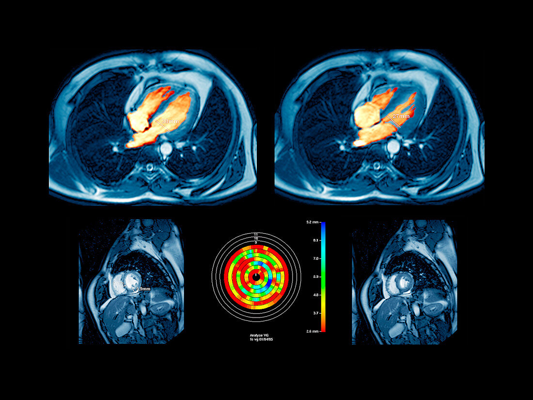 Heartbeat,MRI