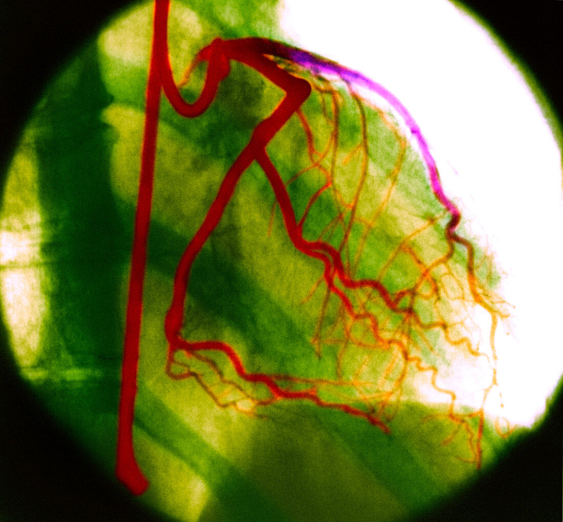 Heart arteries,X-ray