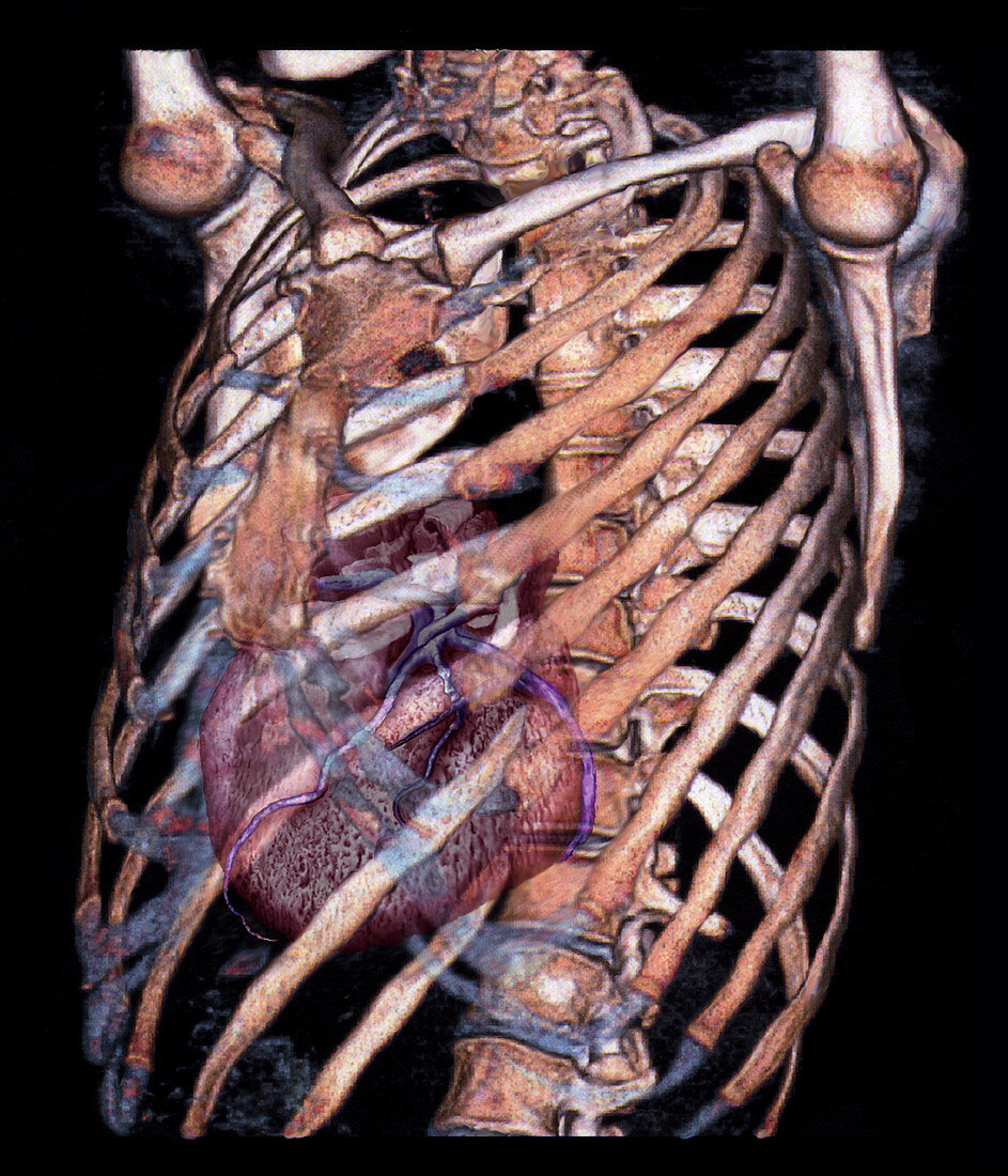 Heart and rib cage,3D CT scan