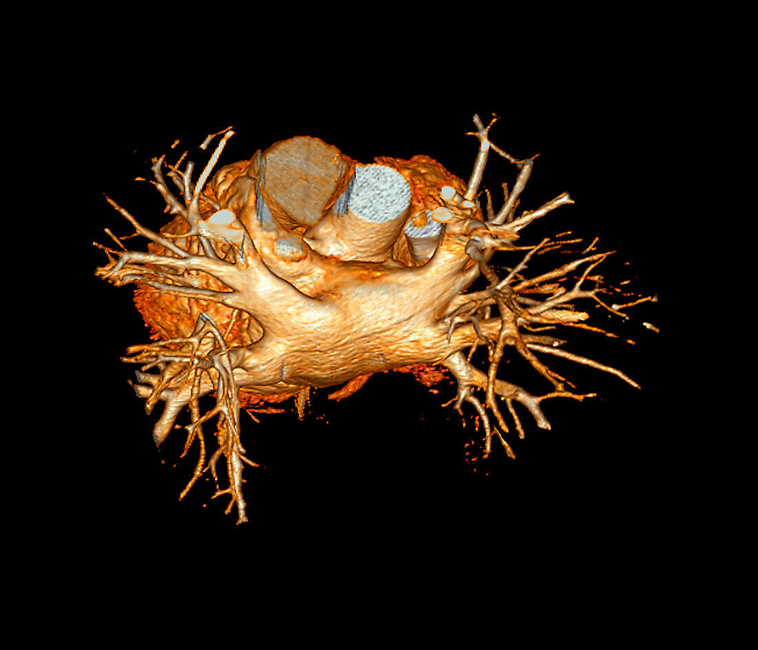 Heart,3D CT scan