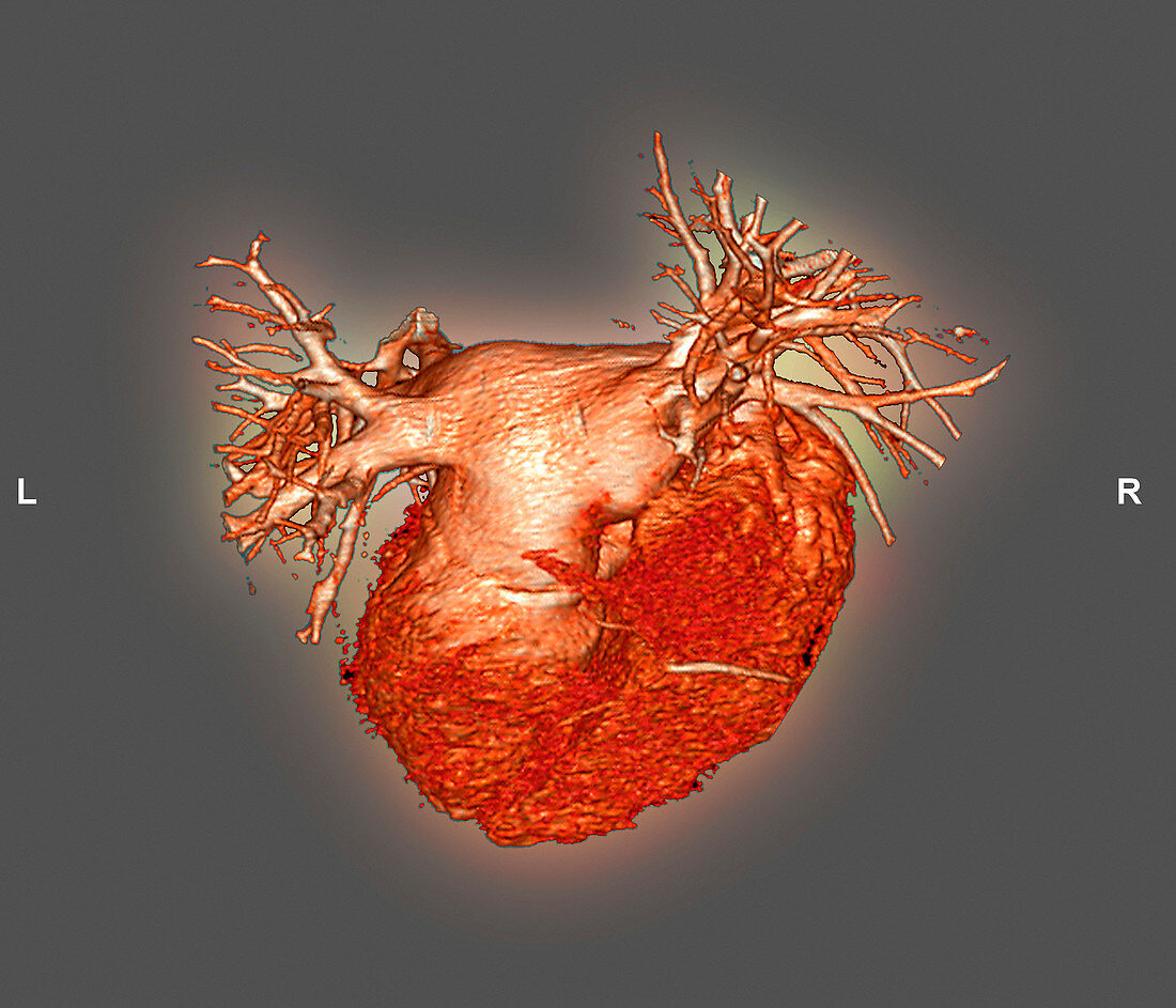 Heart,3D CT scan