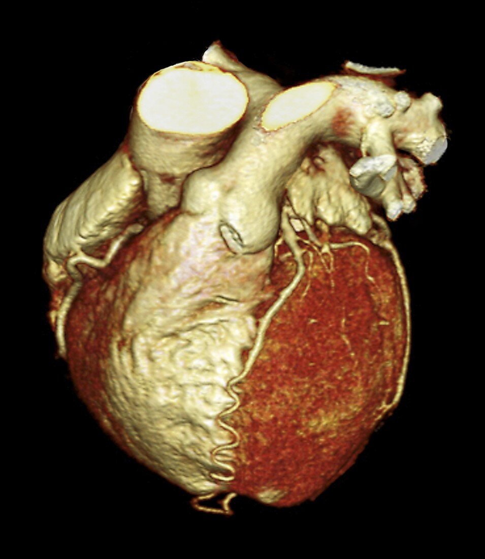 Heart,3D CT scan