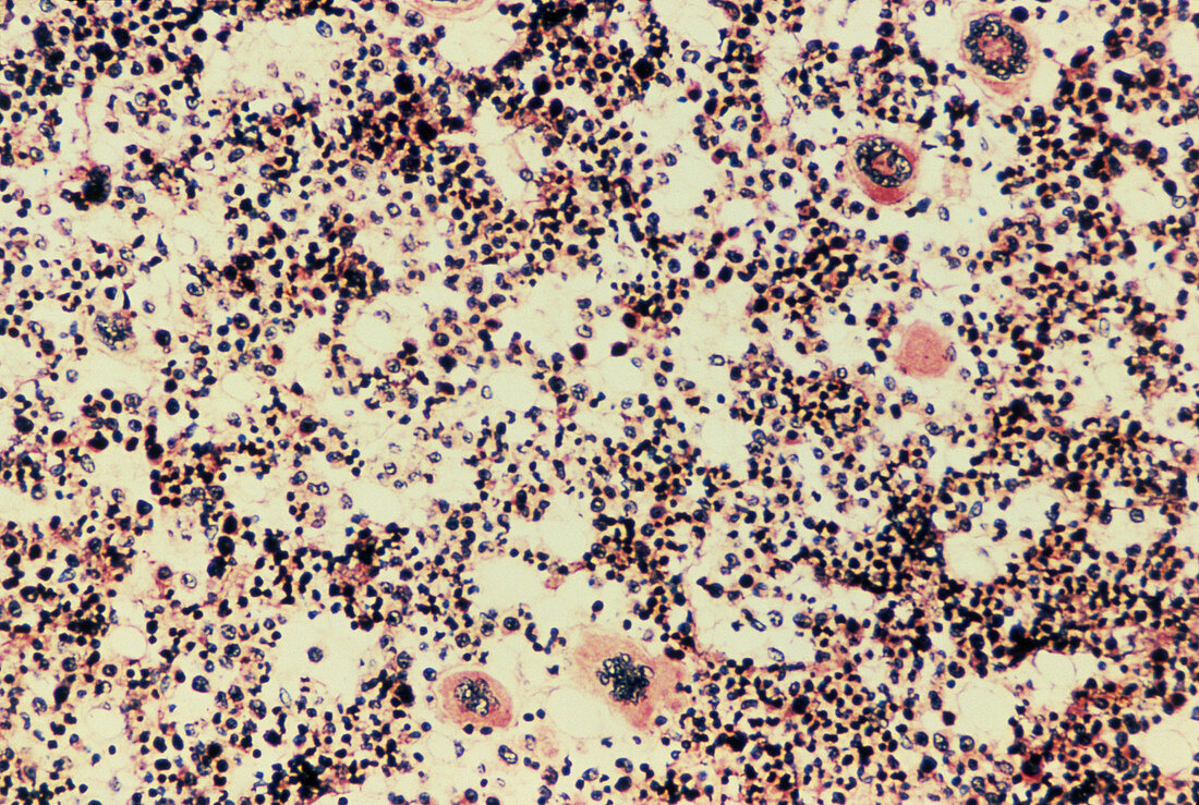 Developing blood cells seen in the bone marrow