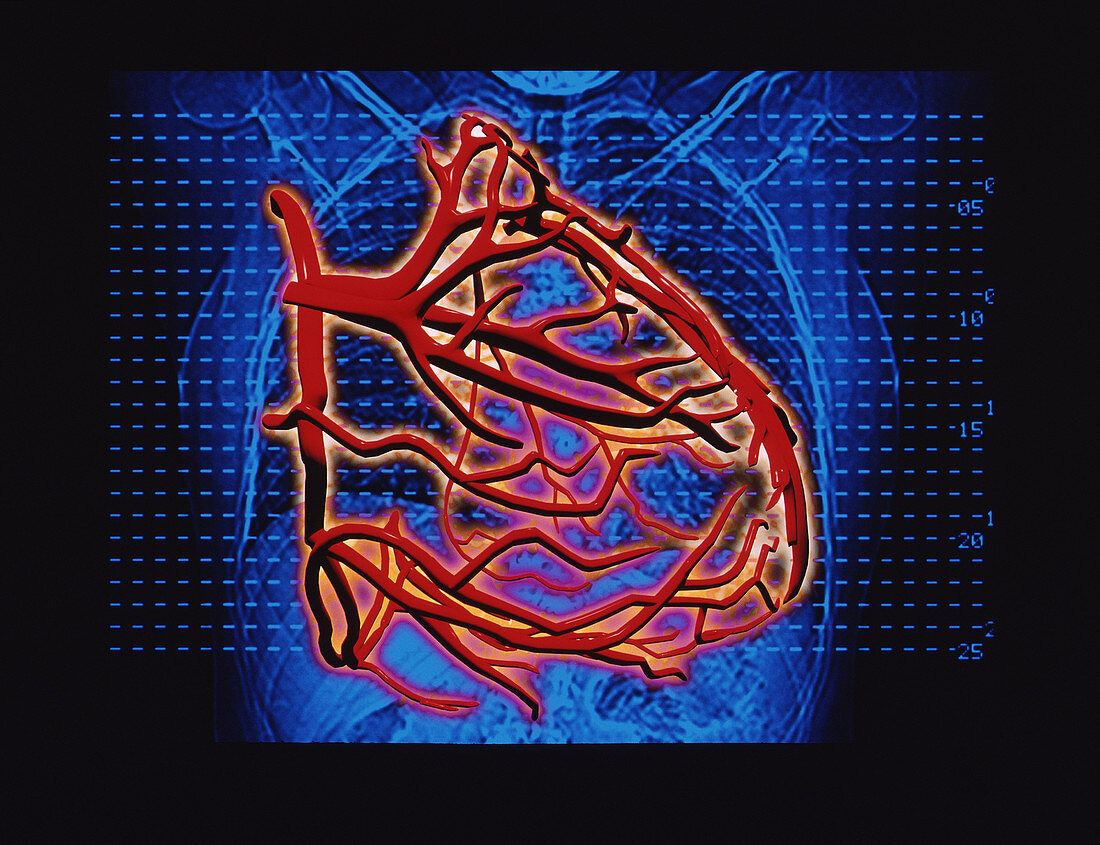 Computer artwork of blood supply to the heart