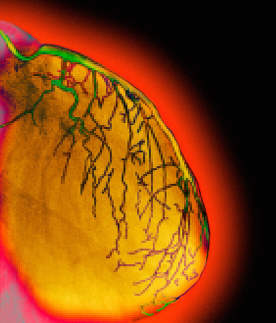 Coloured angiogram of coronary arteries of heart