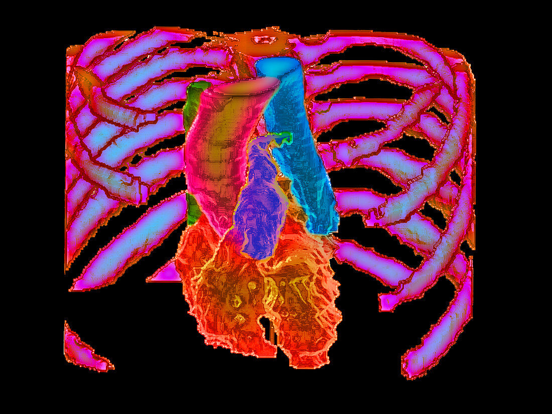 Coloured 3-D CT scan of healthy heart in ribcage