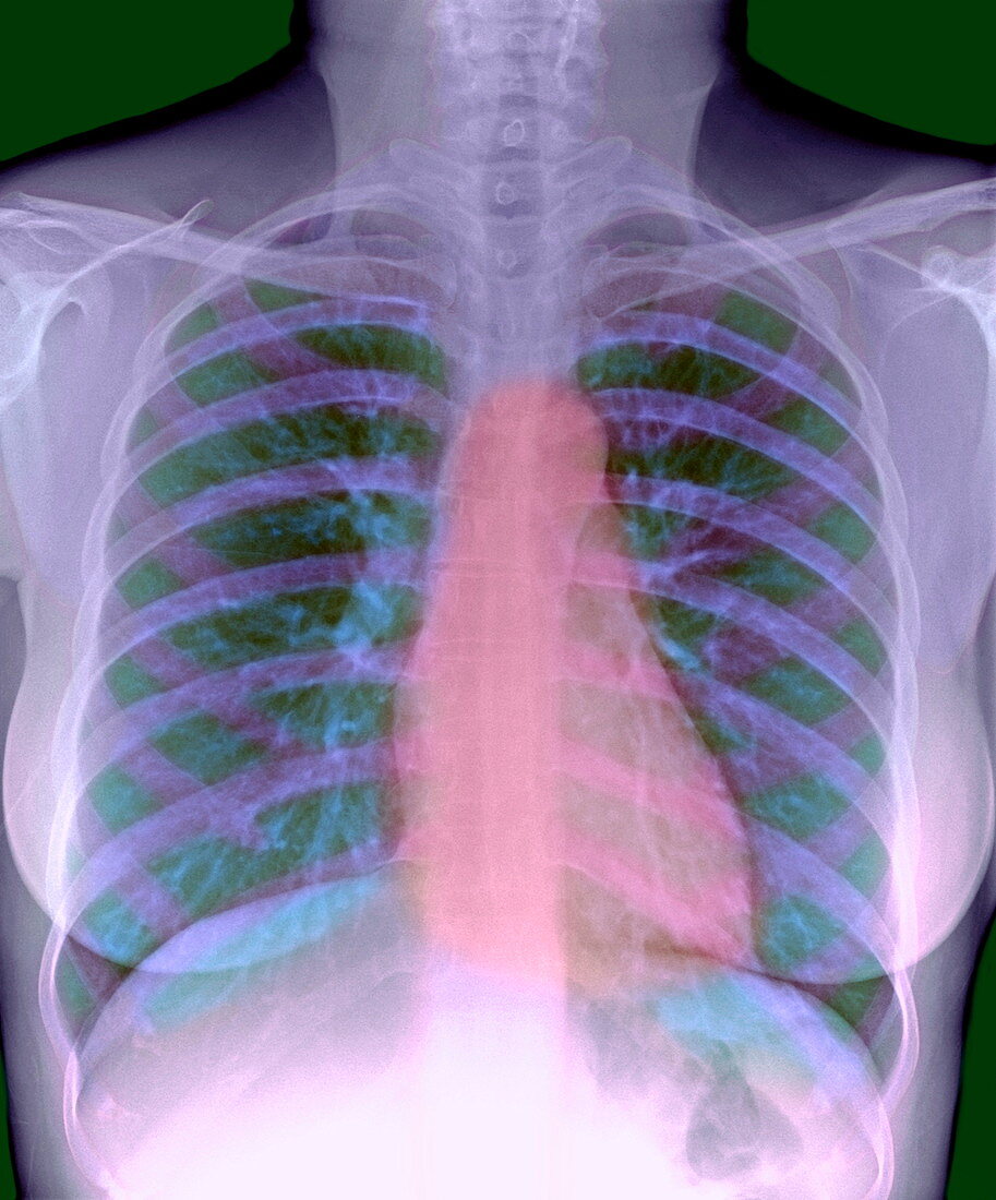 Heart,chest X-ray