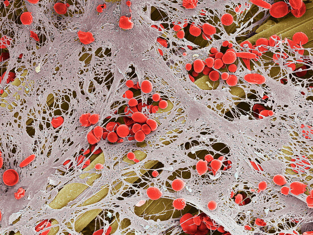 Blood clot on plaster,SEM