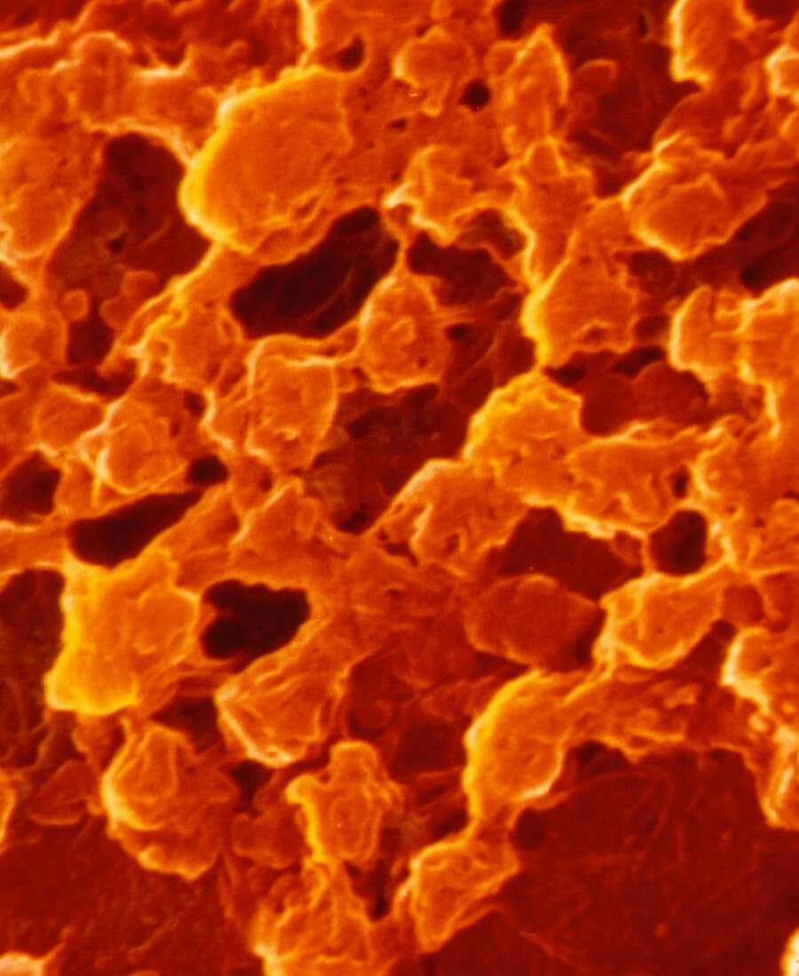 False-colour SEM of aggregates of blood platelets