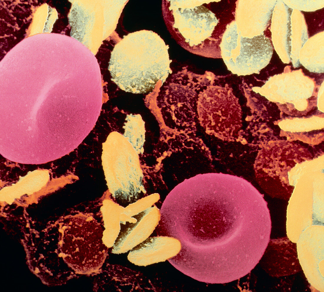 Coloured SEM of blood platelets & red blood cells