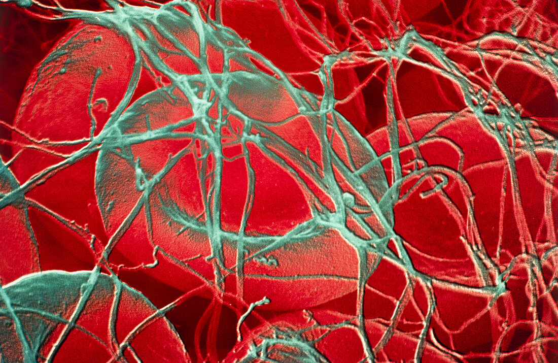 False-colour SEM of a human blood clot