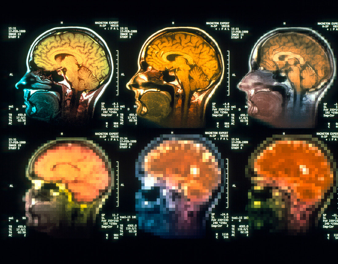 Conceptual MRI scans of a brain disorder