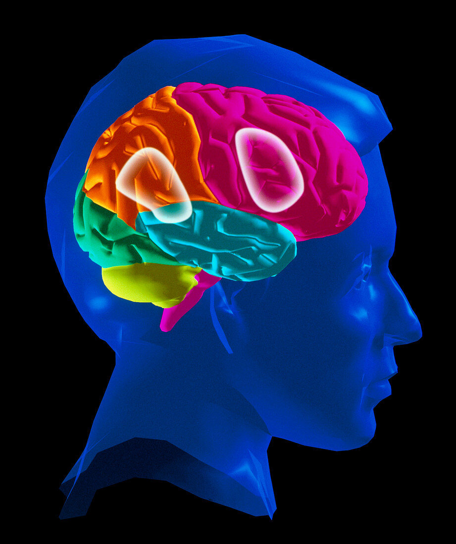 Computer artwork: human brain showing speech areas