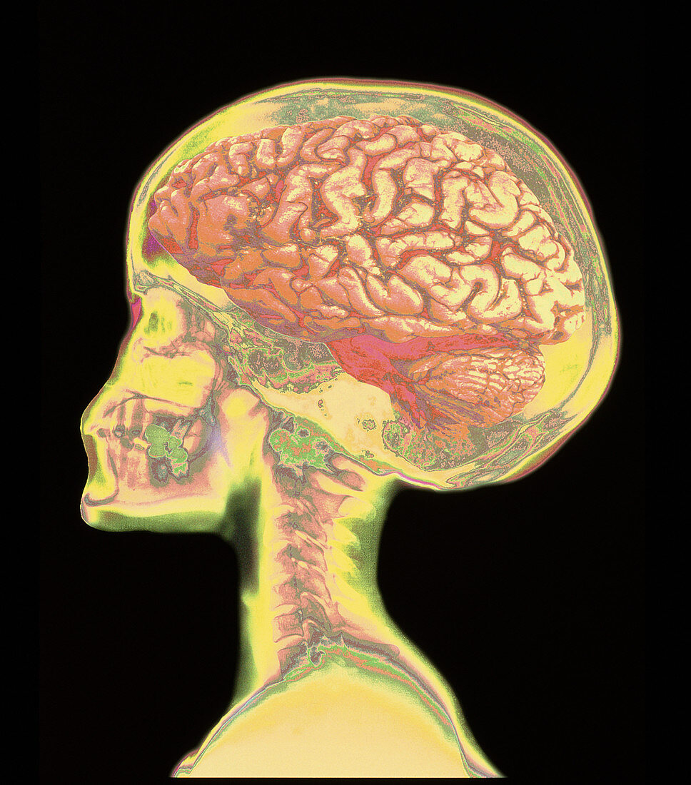 Brain superimposed on colour X-ray of human skull