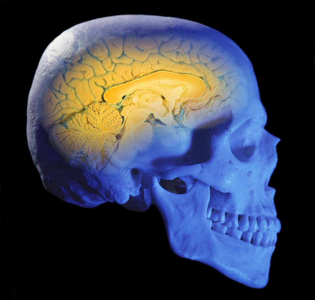 Human skull and brain