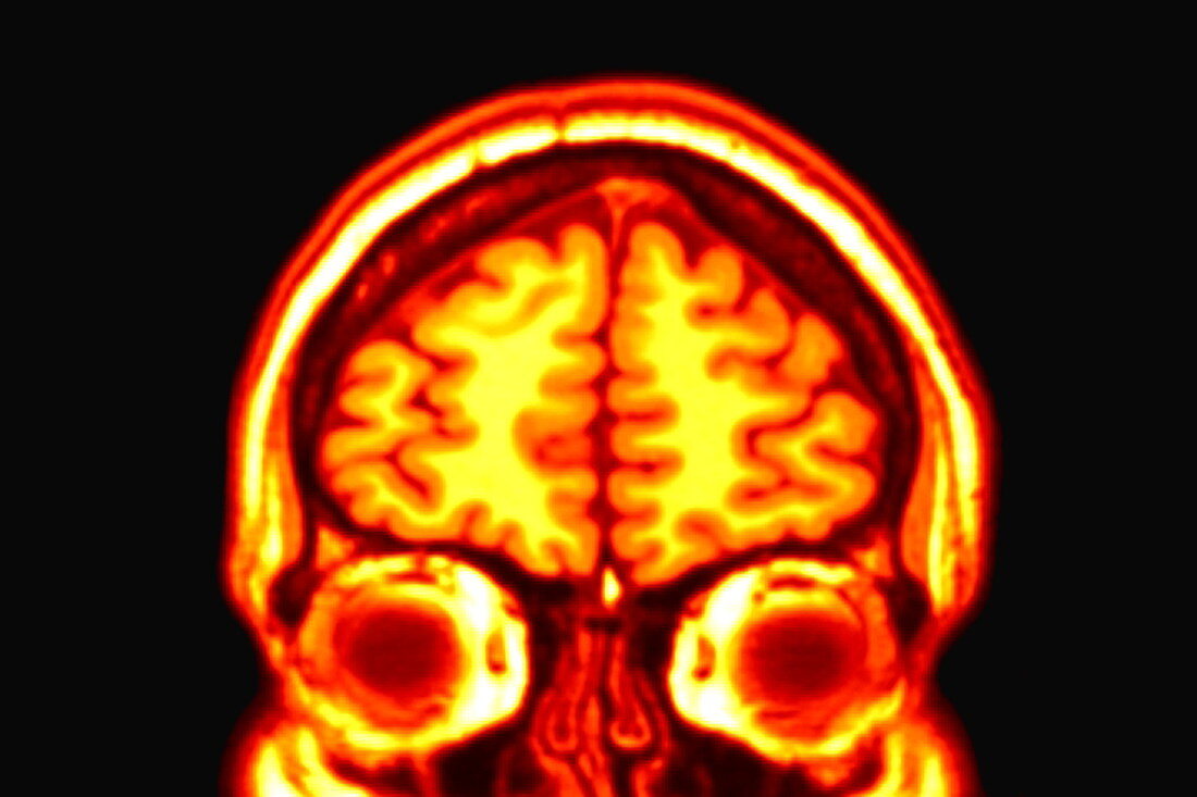 Brain,MRI scan