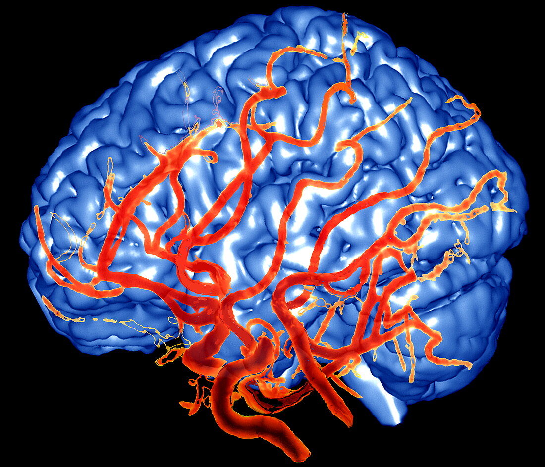 Brain and arteries,3-D MRA scan