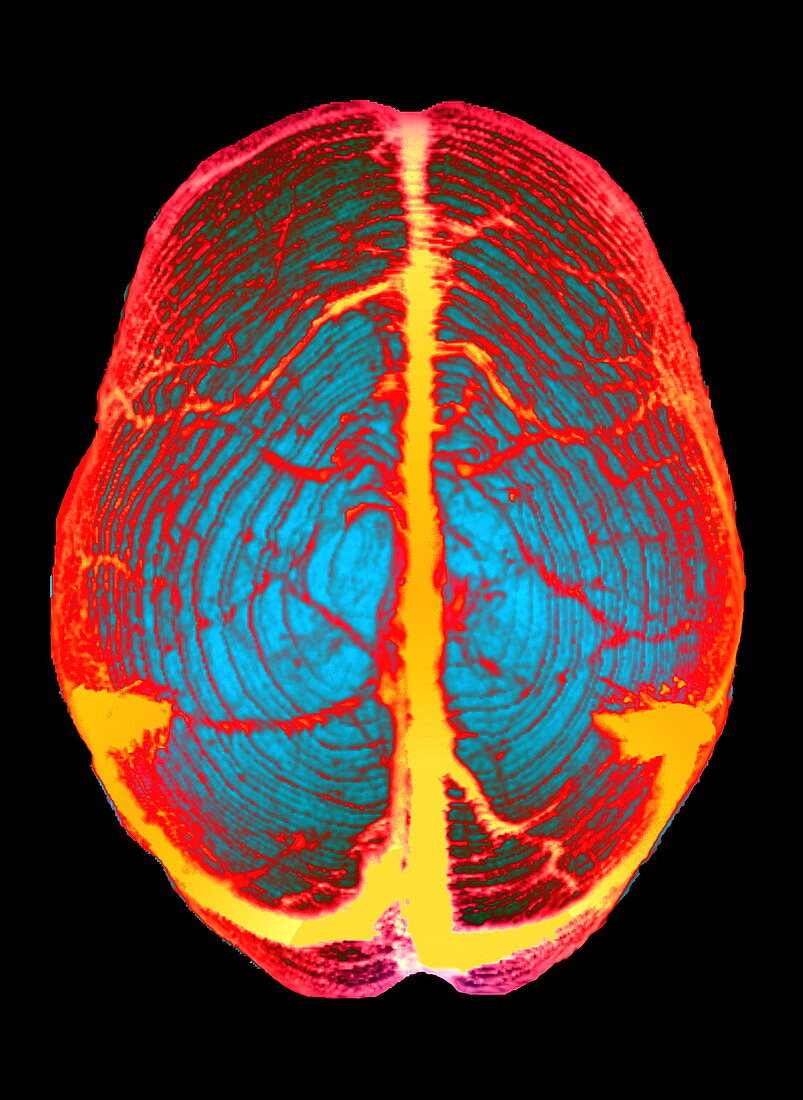 Venous sinuses in brain,CT scan