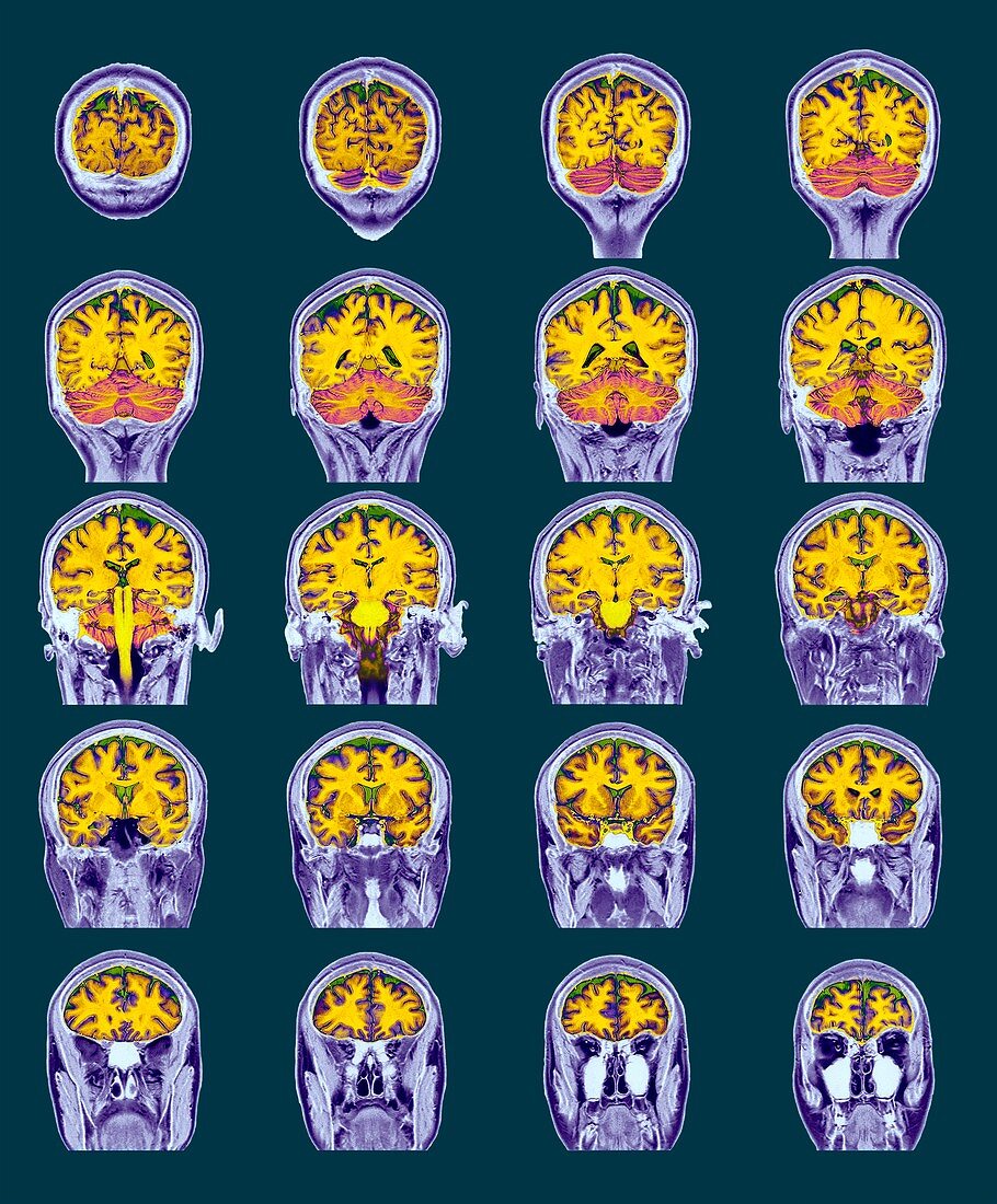 Healthy brain,MRI scans