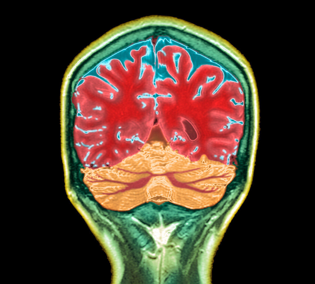 Healthy brain,MRI scan