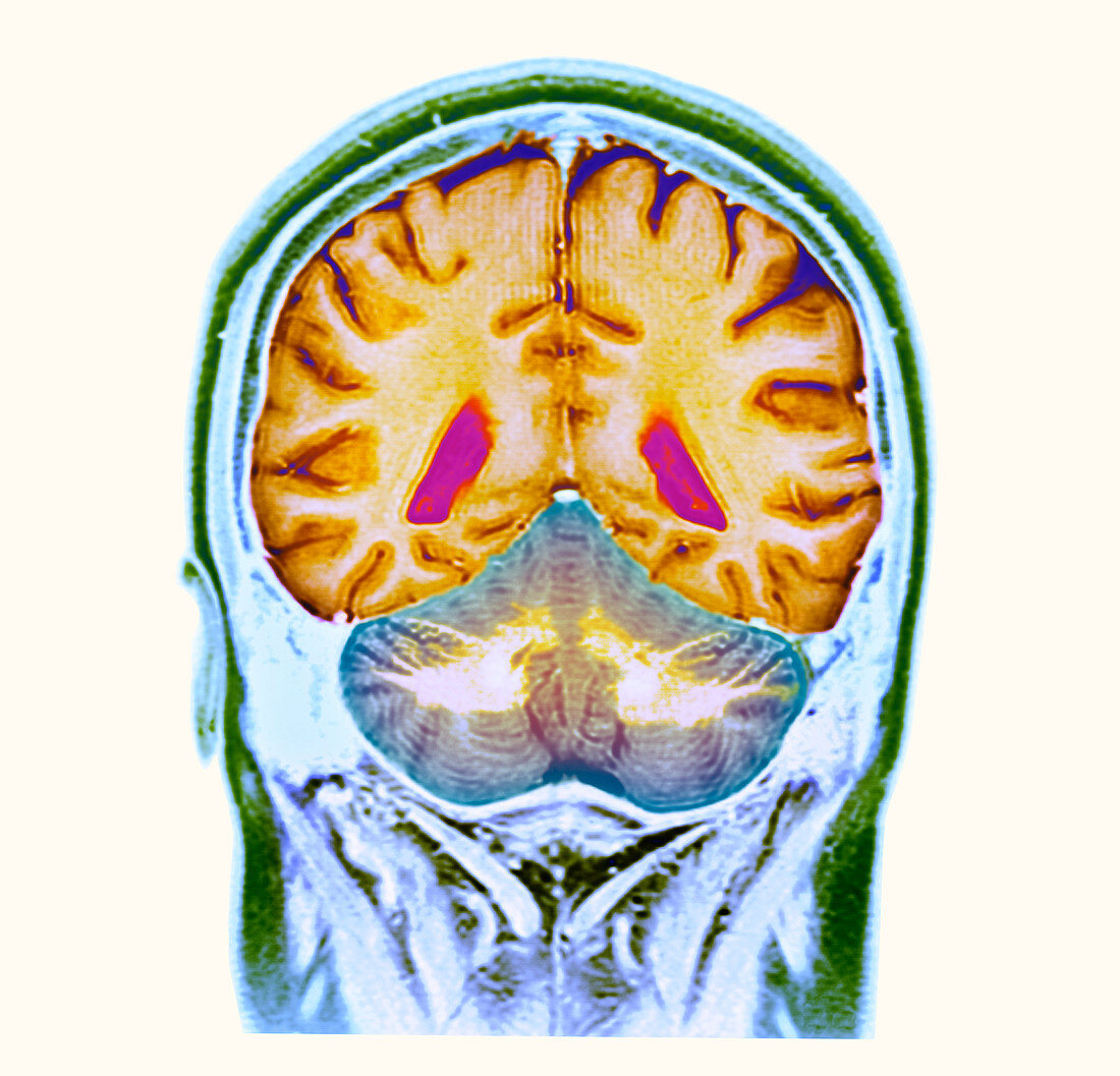 Healthy brain,MRI scan