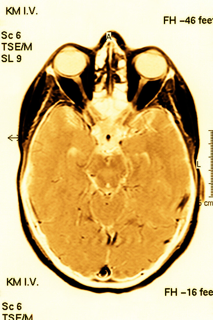 Brain scan,MRI scan