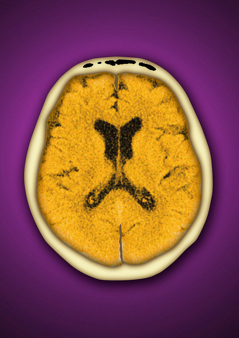 Healthy brain,CT scan