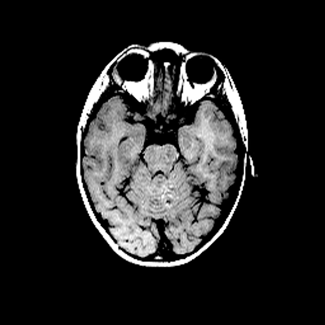 Child's brain,MRI scan