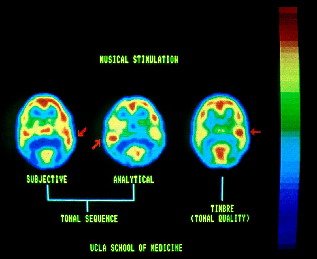 Positron Computed Tomograph brain scans