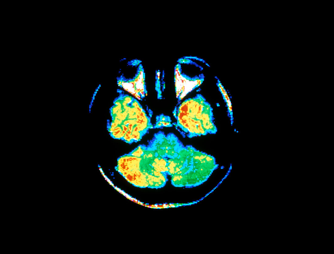 MRI scan of healthy human brain