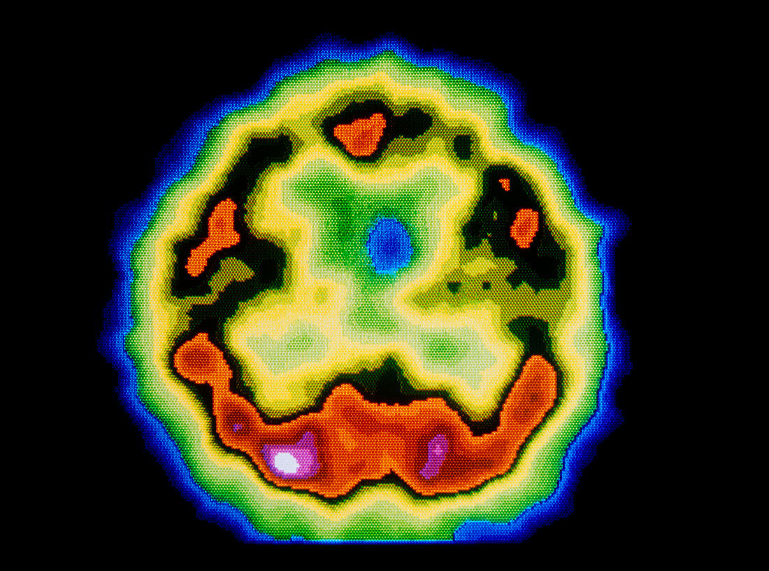 PET scan of an axial section through a human brain