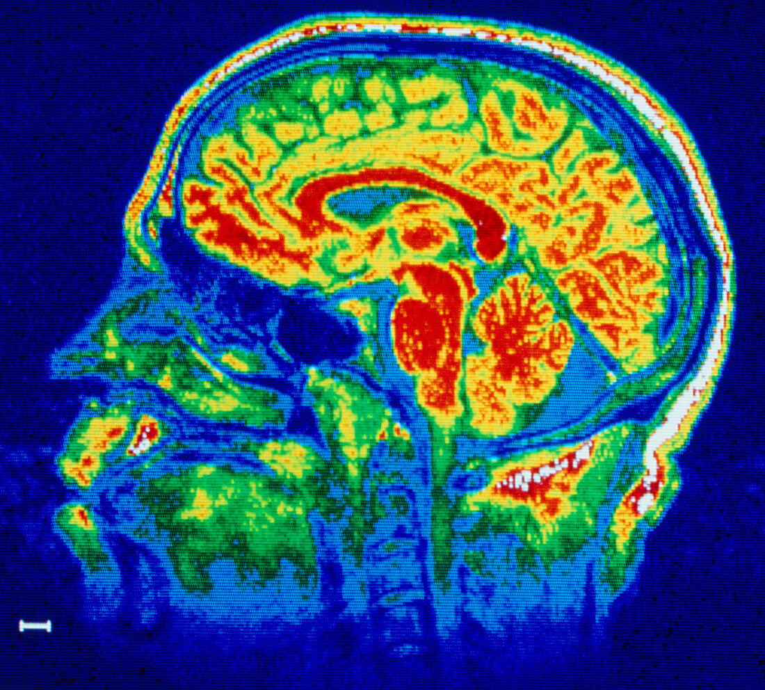 False-colour sagittal NMR scan of a child's head