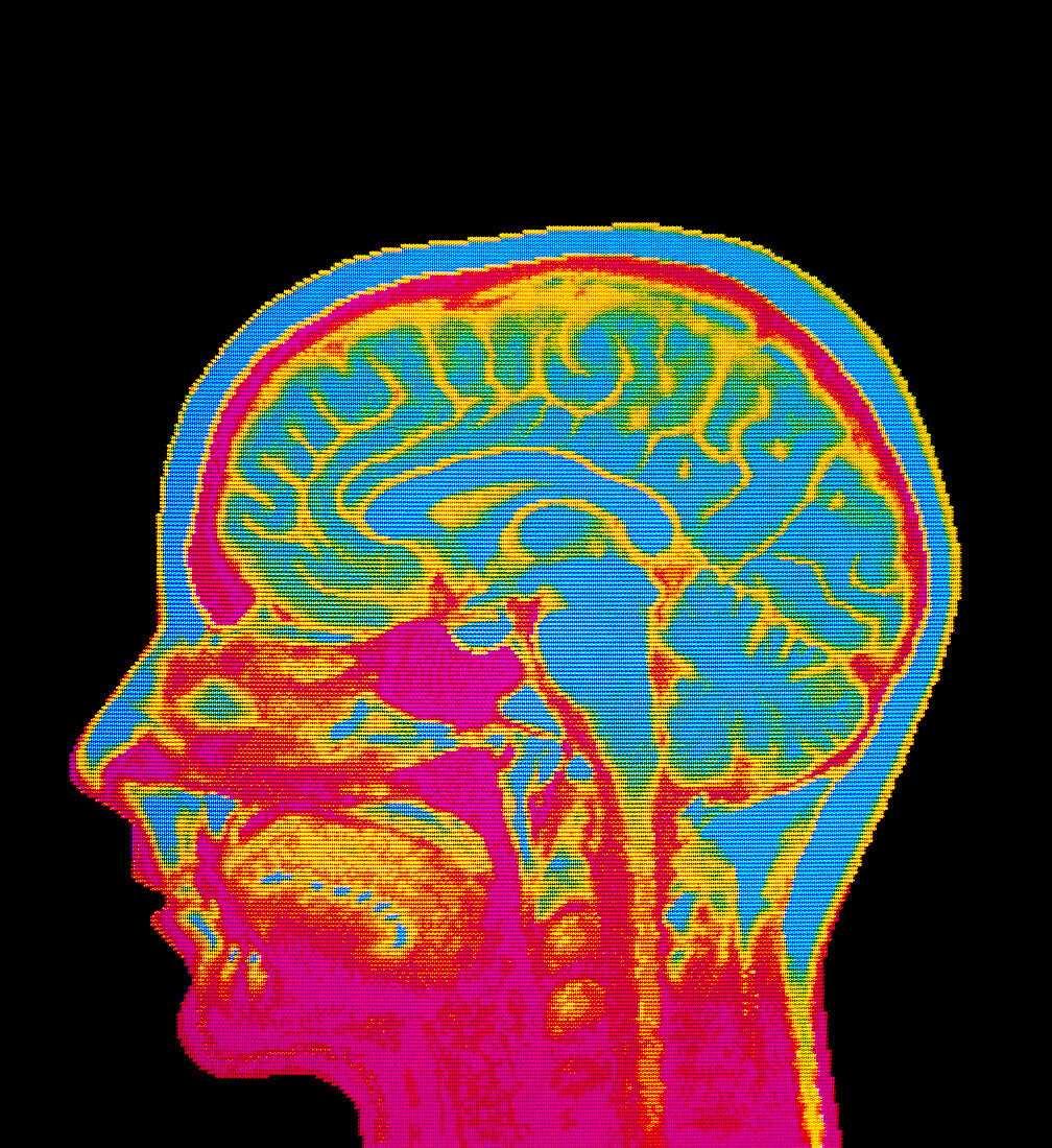 MRI scan of normal brain