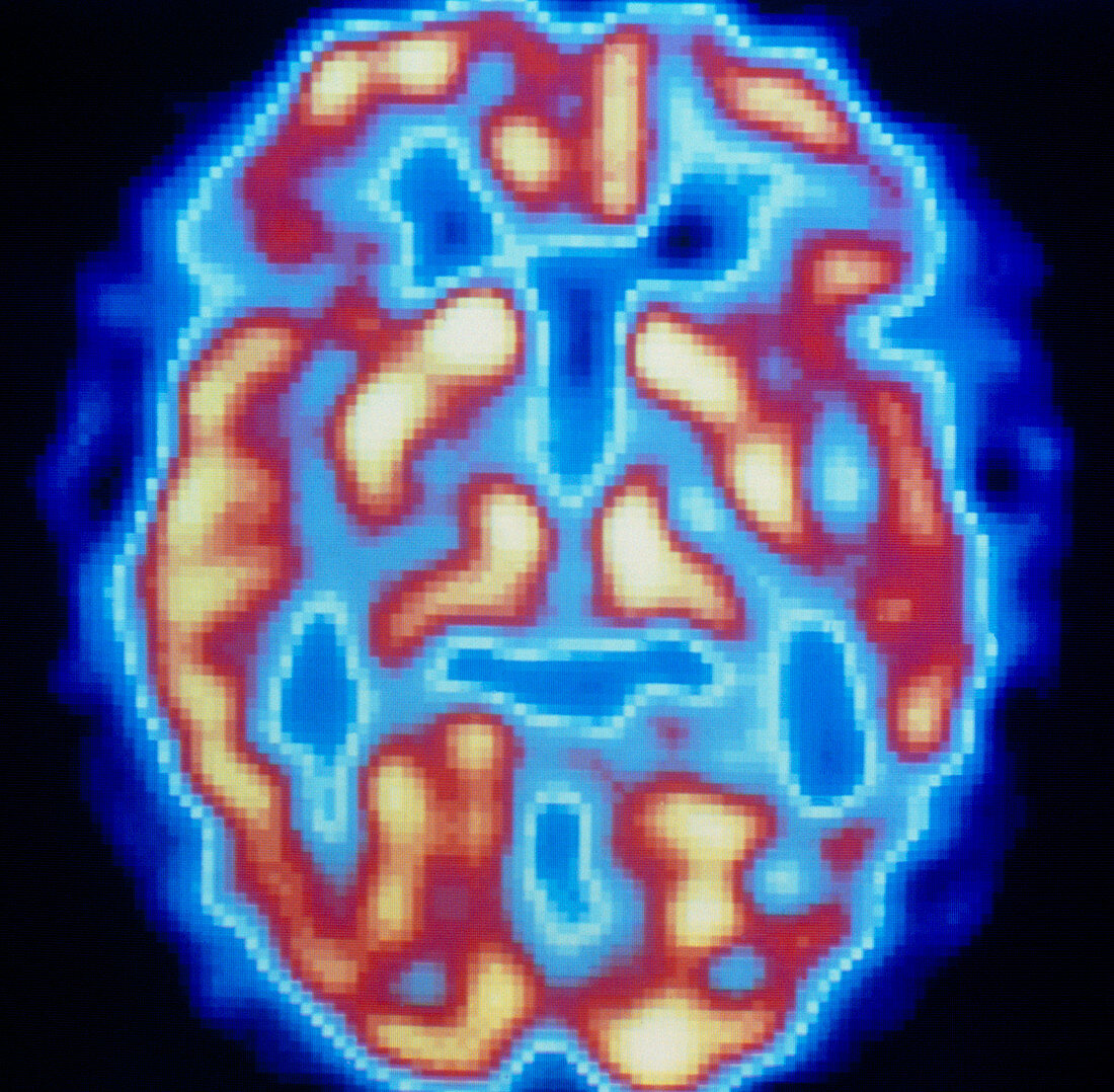 PET scan of brain of normal subject