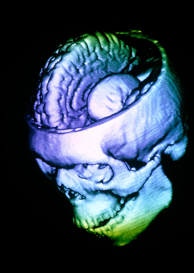 Coloured 3-D CT scan of the brain within the skull