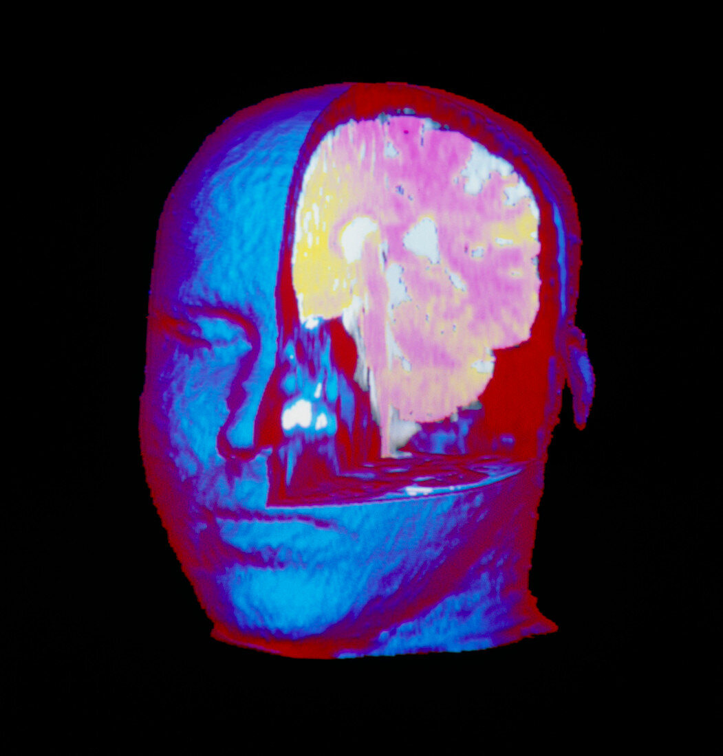 Coloured 3-D MRI scan of human brain in the head