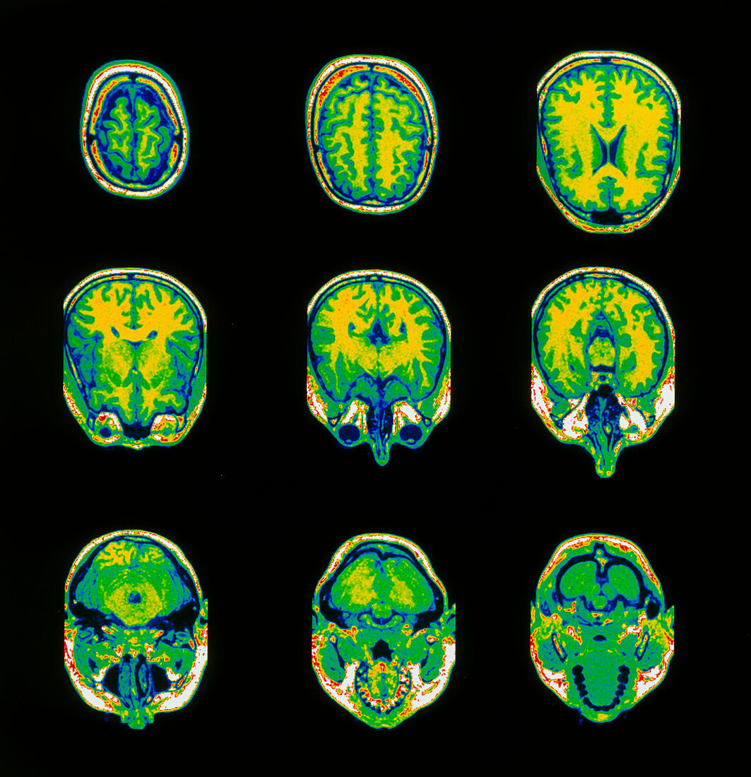 Coloured MRI scans of the brain,horizontal view
