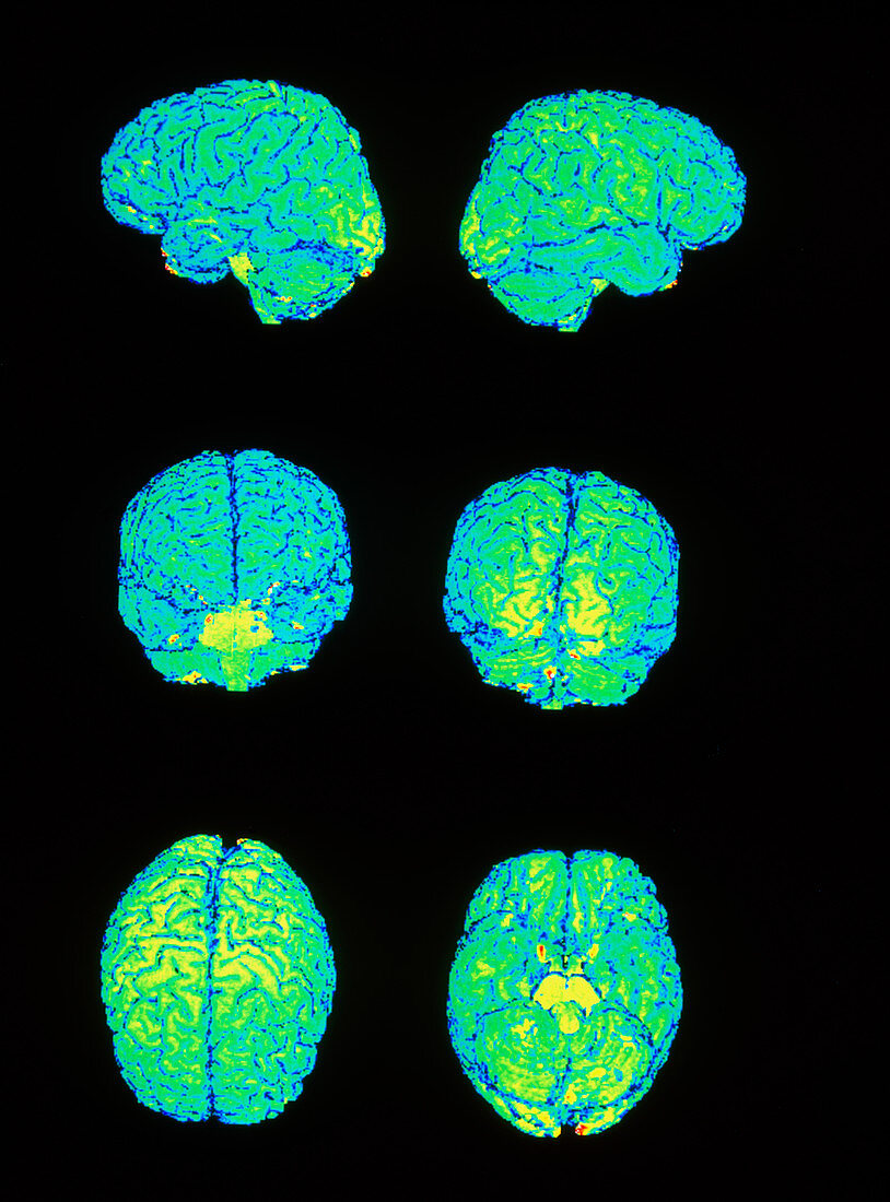 Coloured 3-D MRI scans of external brain (6 views)